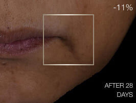 Close-up van de huid voor de behandeling, met zichtbare neus-lippenplooien en tekenen van veroudering rond de mond.